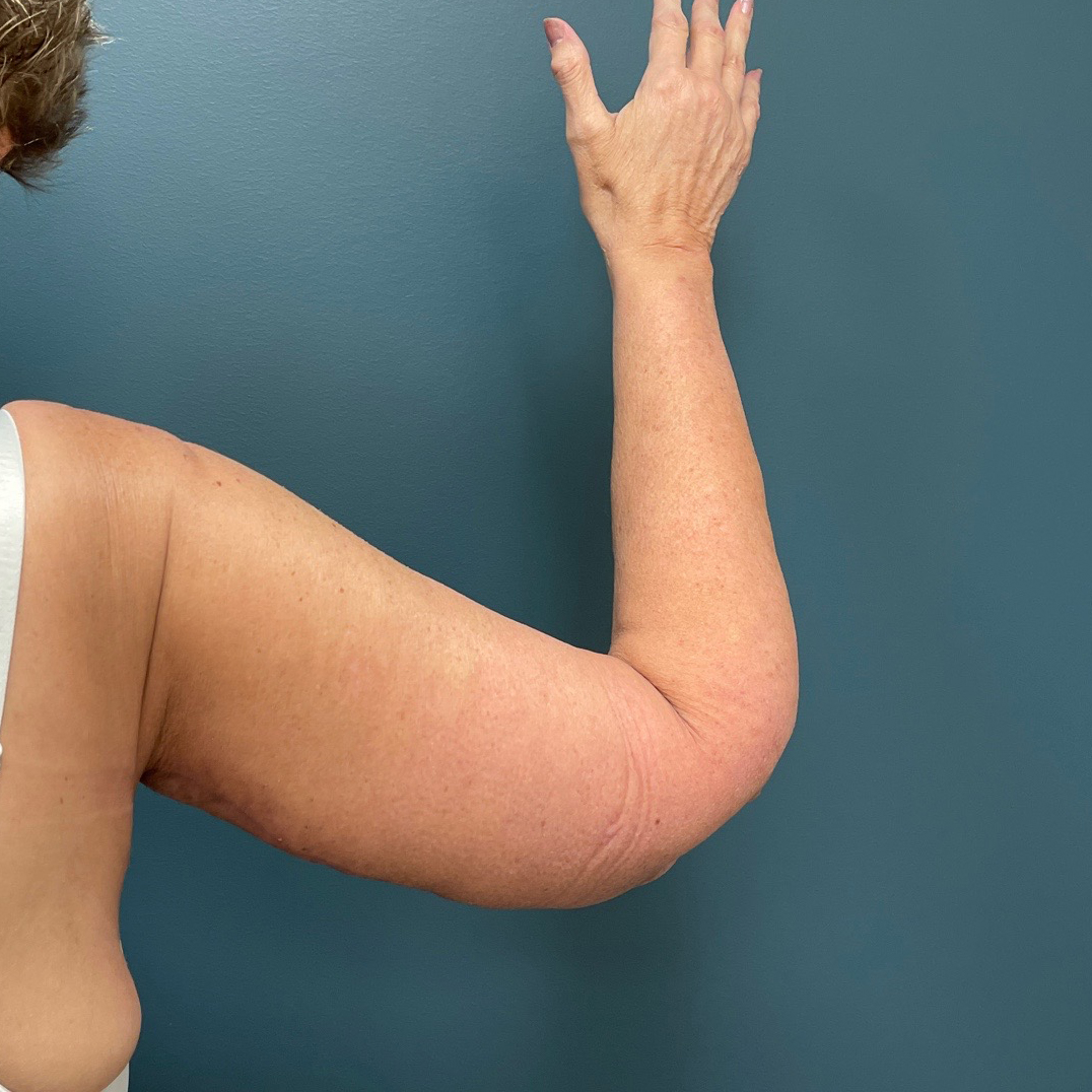 Arm Lift Before & After Patient #1540