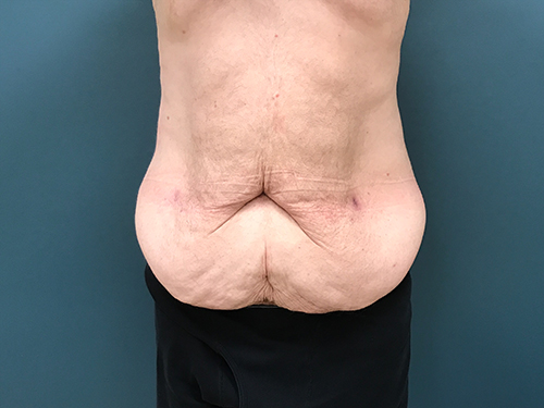 Lower Body Lift Before & After Patient #1721