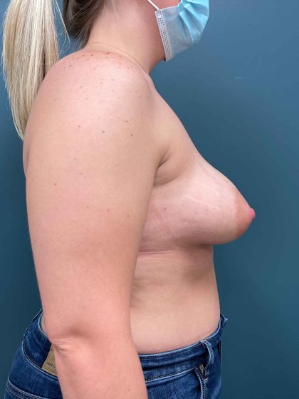 Breast Augmentation Before & After Patient #1688