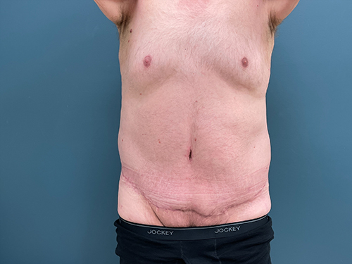 Lower Body Lift Before & After Patient #1721