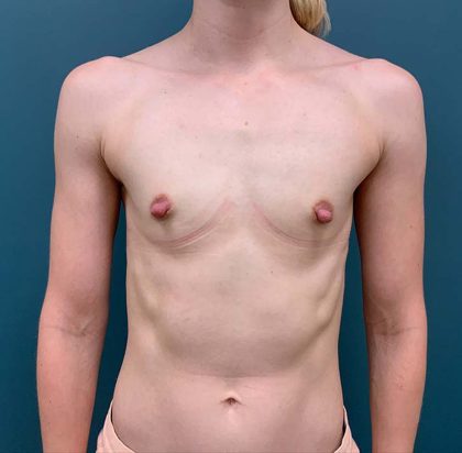 Breast Augmentation Before & After Patient #1756