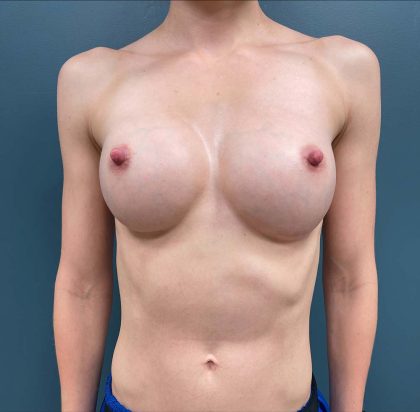 Breast Augmentation Before & After Patient #1756