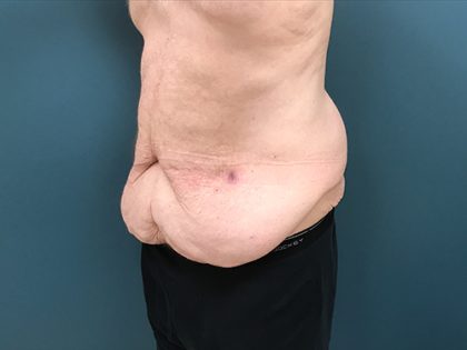 Lower Body Lift Before & After Patient #1721