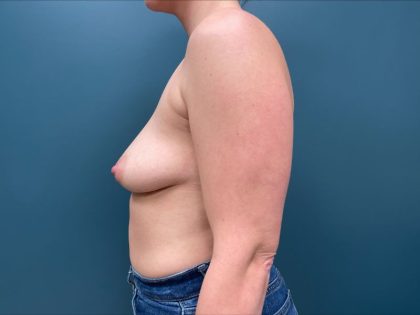 Breast Augmentation Before & After Patient #1700