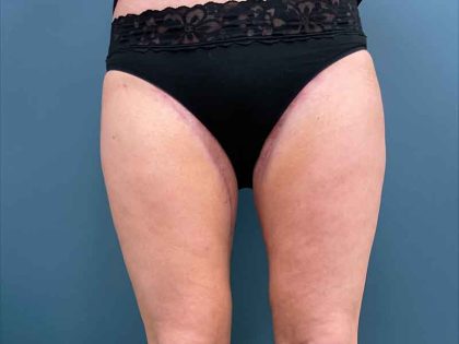 Lower Body Lift Before & After Patient #1895