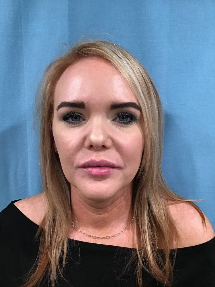 Kysse Lip Filler Before & After Patient #1902