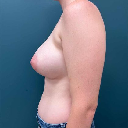 Breast Augmentation Before & After Patient #1885