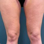 Thigh Lift Before & After Patient #1895