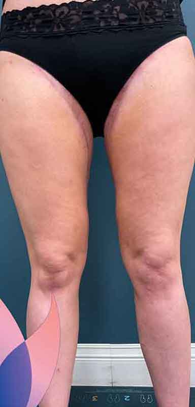 Thigh Lift Before & After Patient #1895