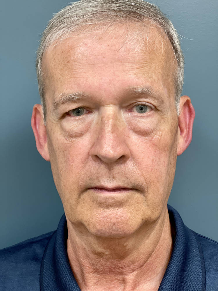 Blepharoplasty Before & After Patient #1869
