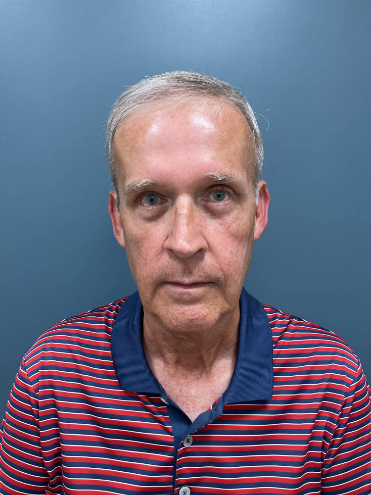 Blepharoplasty Before & After Patient #1869