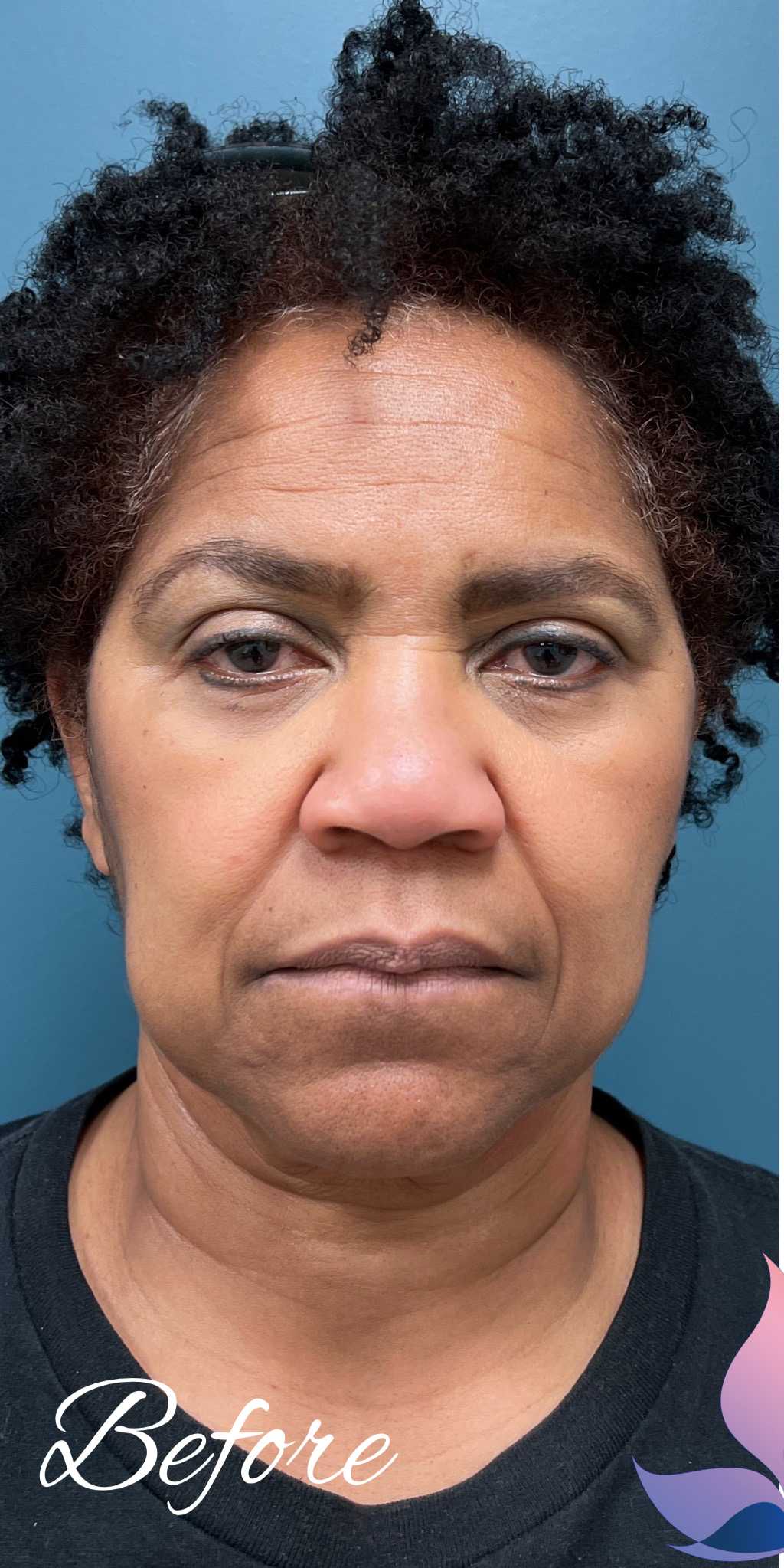 Facelift Before & After Patient #1907