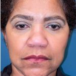 Facelift Before & After Patient #1907