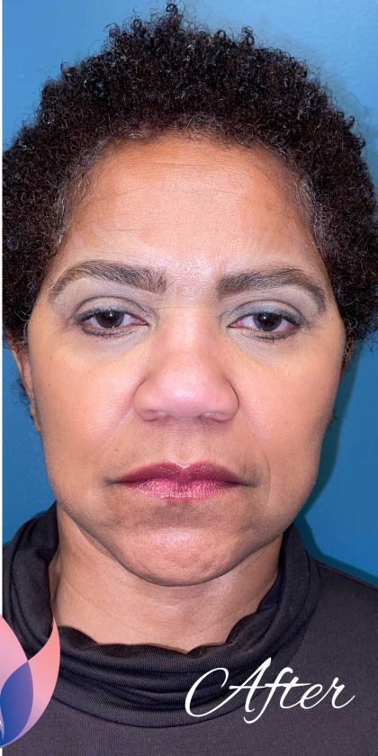 Facelift Before & After Patient #1907