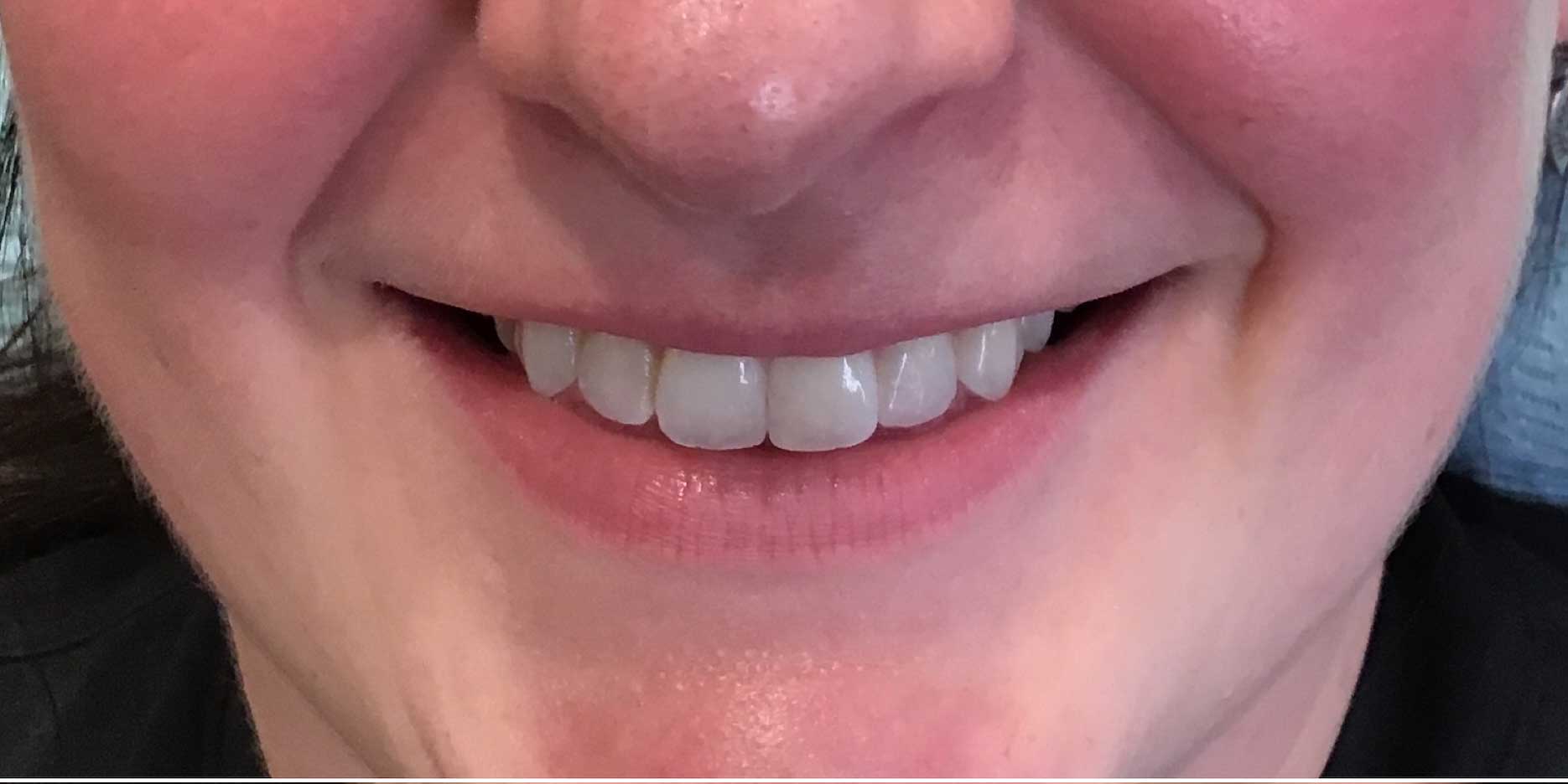 Fillers and Injectables Before & After Patient #1961