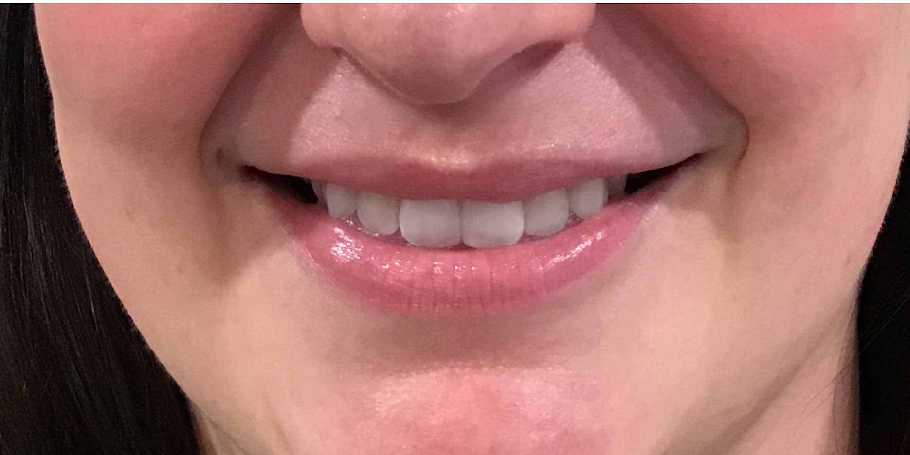 Fillers and Injectables Before & After Patient #1961