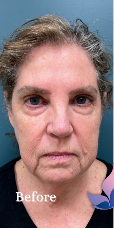 Blepharoplasty Before & After Patient #1984