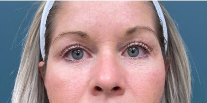 Blepharoplasty Before & After Patient #1993