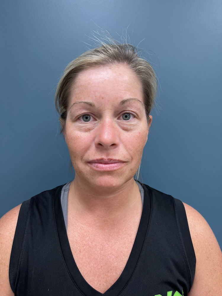Blepharoplasty Before & After Patient #1993