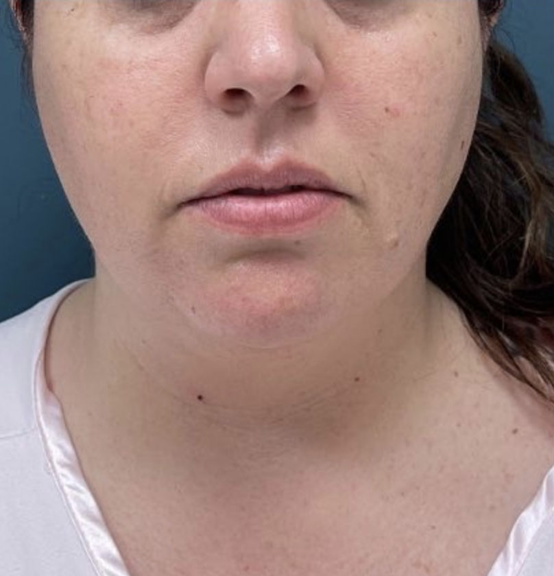 Chin Liposuction Before & After Patient #1987