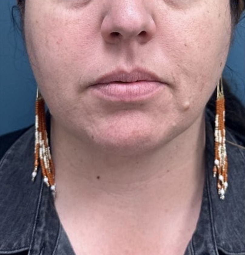 Chin Liposuction Before & After Patient #1987