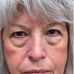 Blepharoplasty Before & After Patient #2071