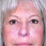 Blepharoplasty Before & After Patient #2071