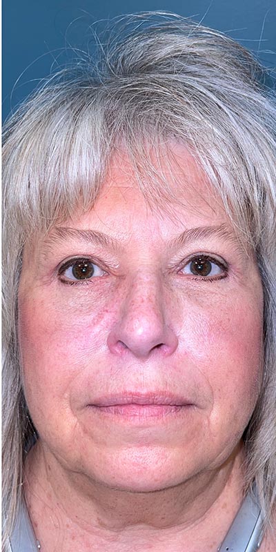 Blepharoplasty Before & After Patient #2071