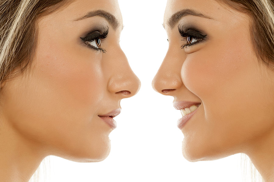 PROCEDURE OF THE WEEK: Nasal Surgery (Rhinoplasty)