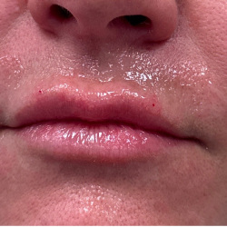 Kysse Lip Filler Before & After Patient #2129