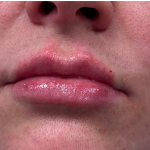 Kysse Lip Filler Before & After Patient #2129