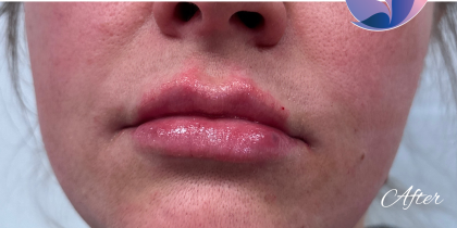 Kysse Lip Filler Before & After Patient #2129
