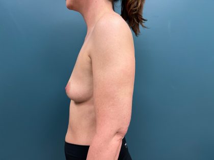 Breast Augmentation Before & After Patient #2118