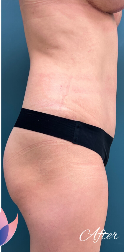 Tummy Tuck Before & After Patient #2221