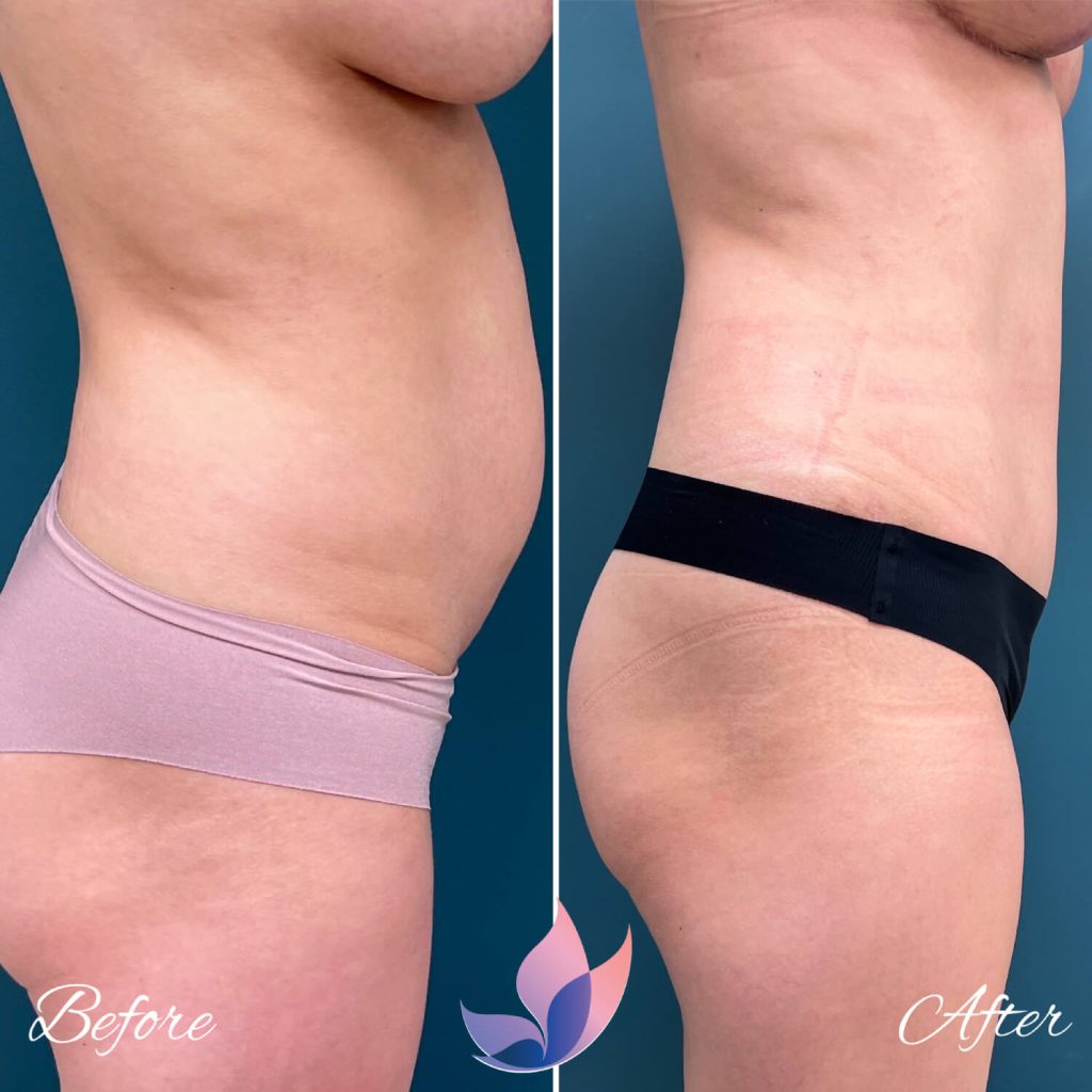 Will a Tummy Tuck Help Promote Continued Weight Loss?