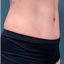 Tummy Tuck Before & After Patient #2221