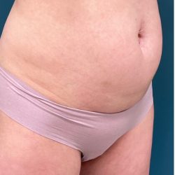 Tummy Tuck Before & After Patient #2221