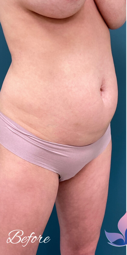 Tummy Tuck Before & After Patient #2221
