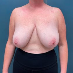Breast Lift Before & After Patient #2214