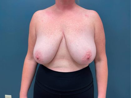 Breast Lift Before & After Patient #2214