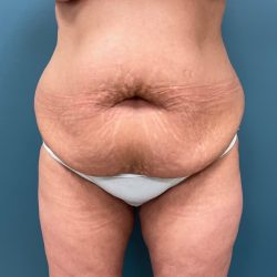 Mommy Makeover Before & After Patient #2179