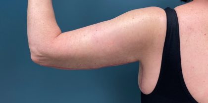 Arm Lift Before & After Patient #2195