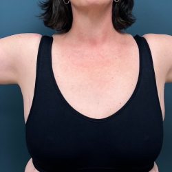 Arm Lift Before & After Patient #2195