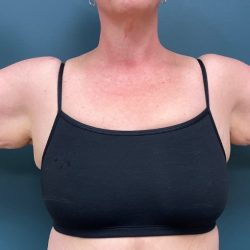 Arm Lift Before & After Patient #2195