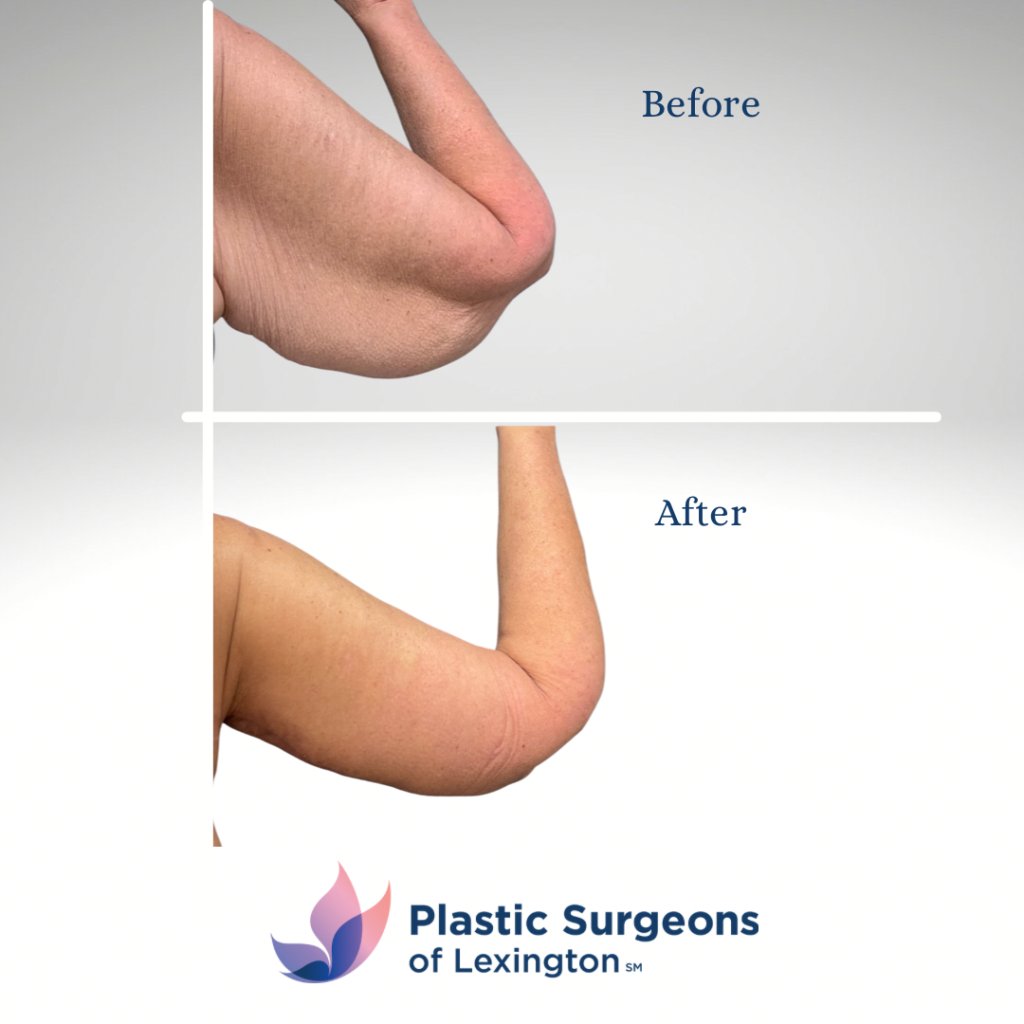 Arm Lipo  Washingtonian Plastic Surgery