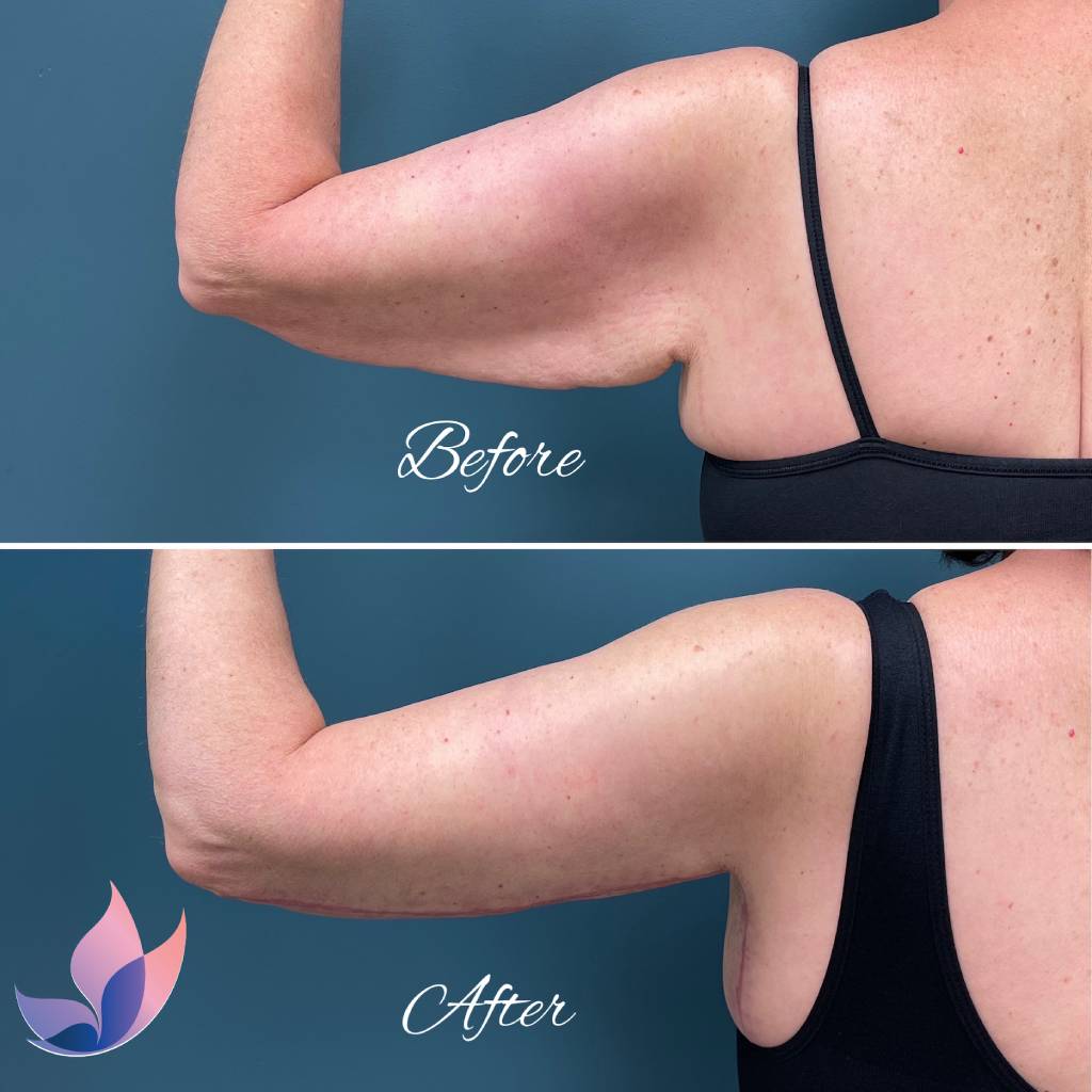 Arm Lift Before and After