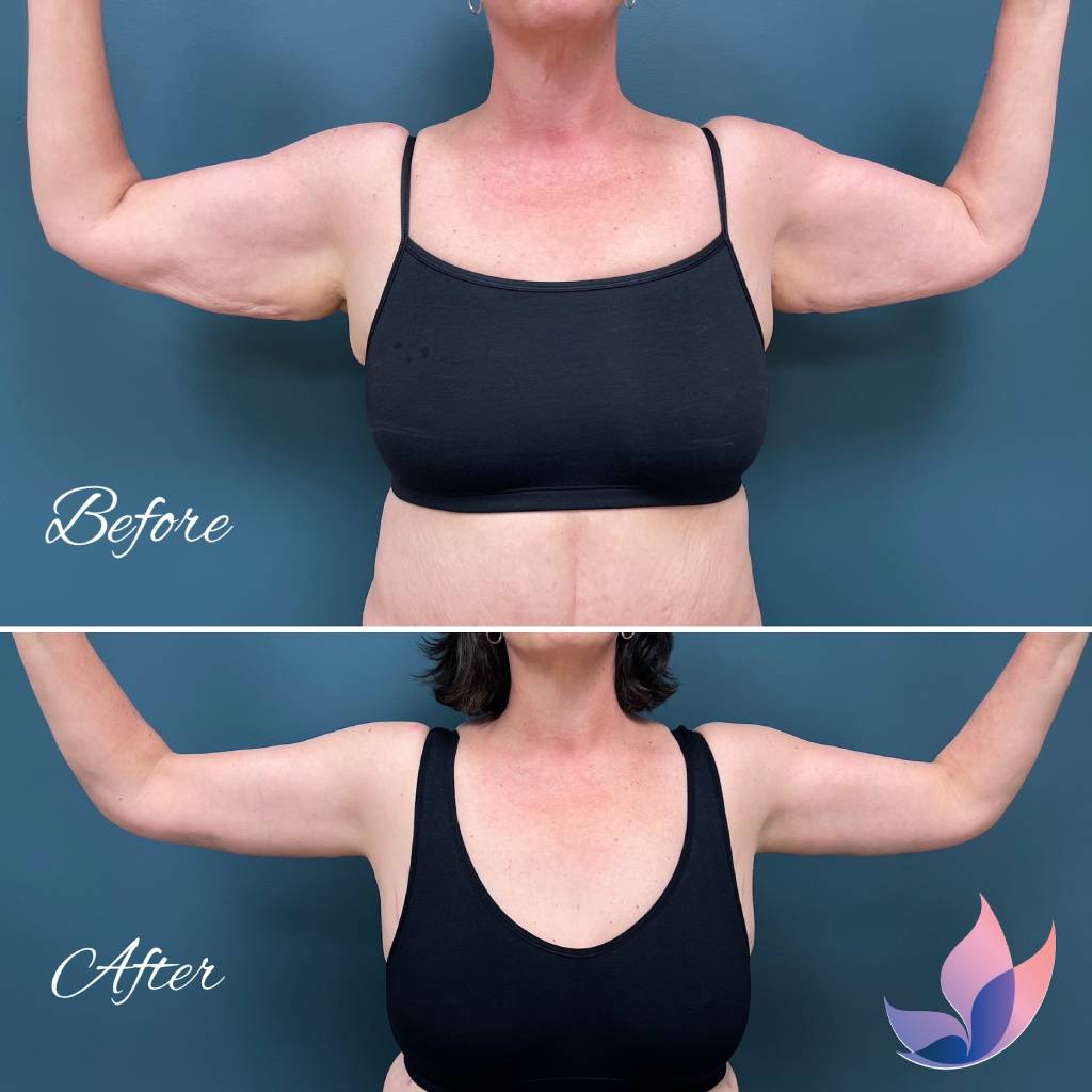 Arm Lift Before and After