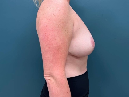 Breast Lift Before & After Patient #2214