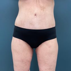 Lower Body Lift Before & After Patient #2278