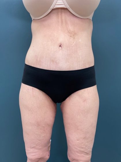 Lower Body Lift Before & After Patient #2278